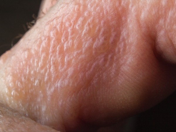 A poison ivy rash on the hand